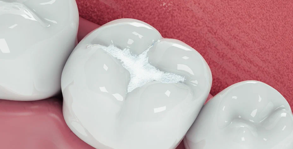 White Fillings For Teeth In Manchester
